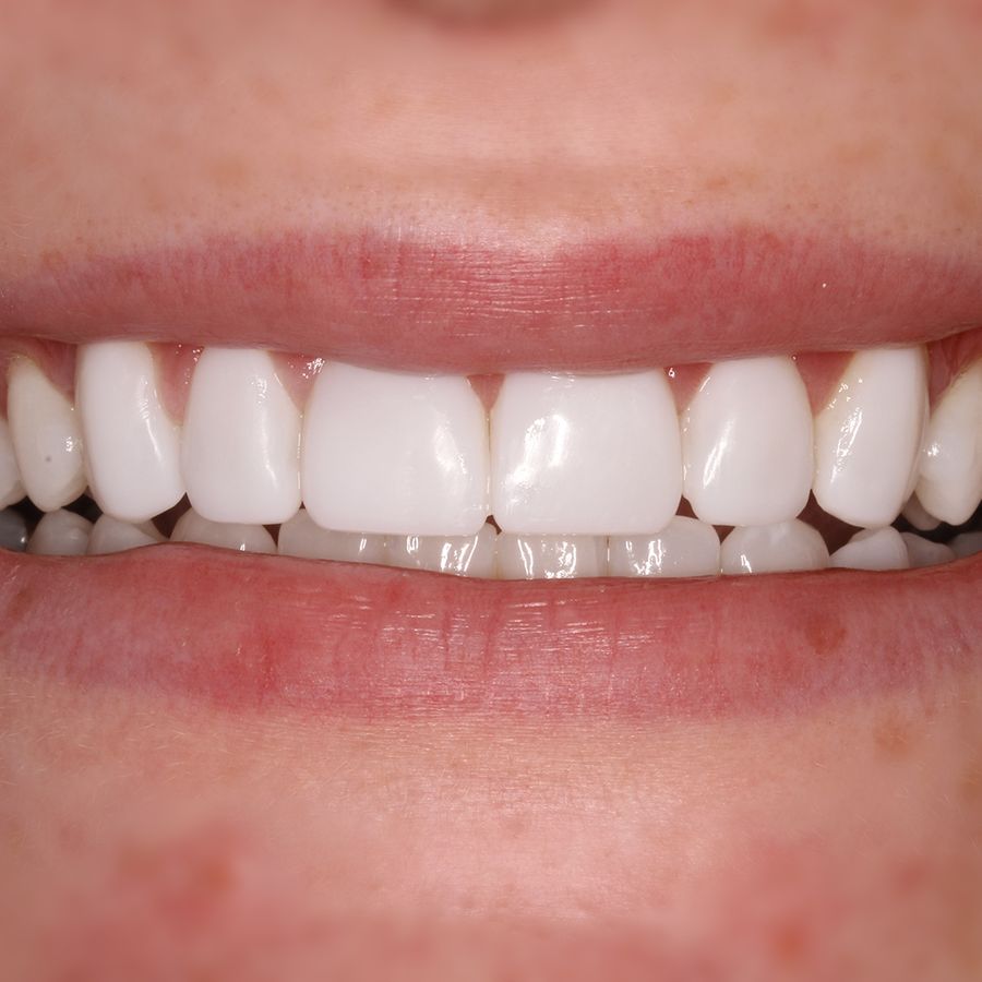 dental bonding - after - 3dental